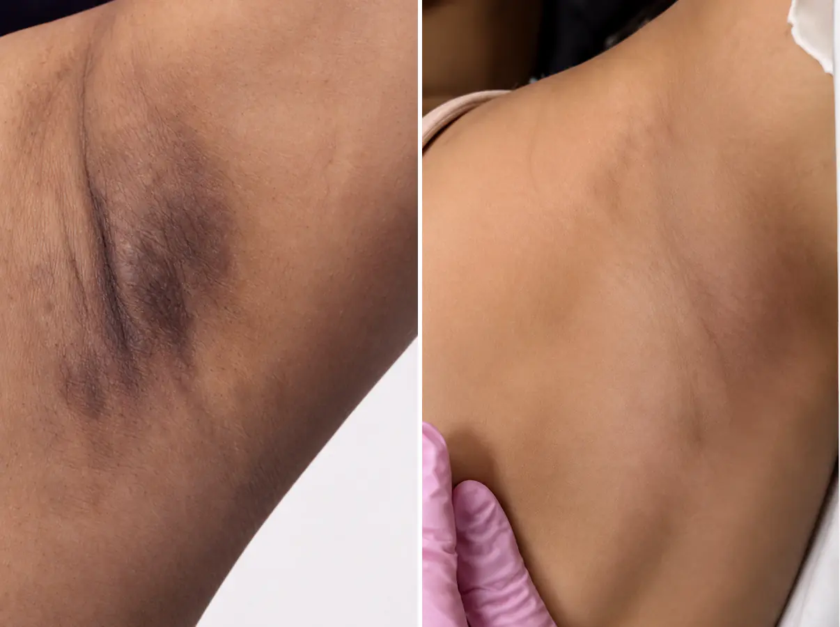 Real client underarm before and after skin brightening: darker pigmentation on the left, lighter and more even on the right