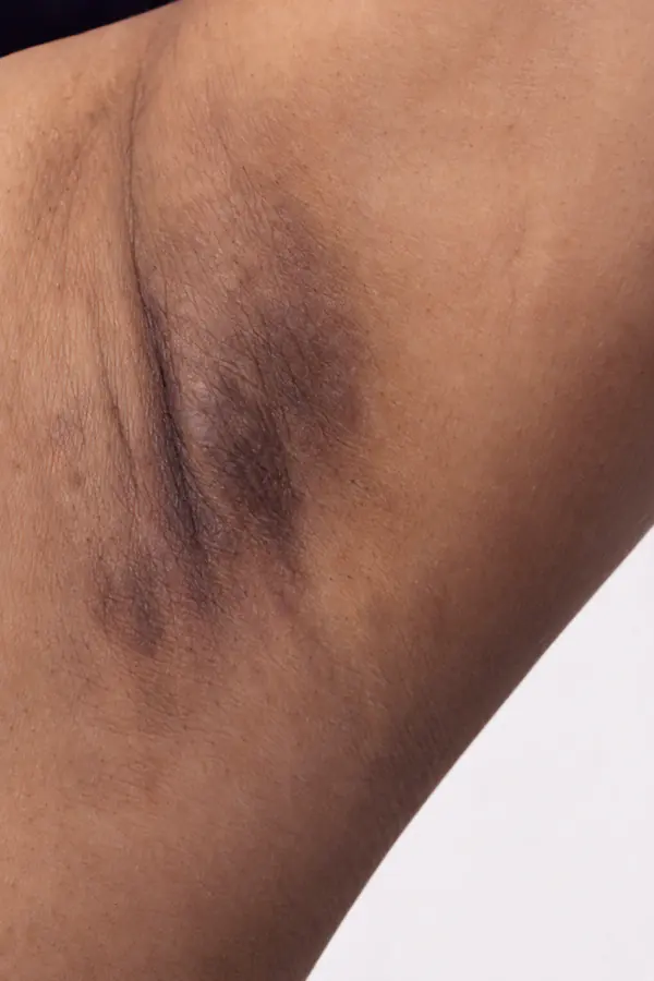 Client underarm before skin brightening, with darker pigmentation